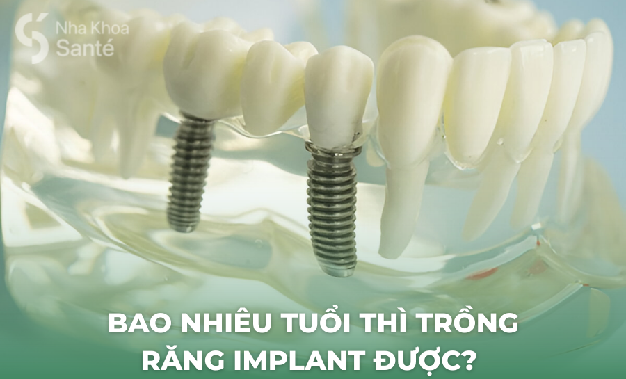 Bao Nhiêu Tuổi Thì Trồng Răng Implant Được? Lời Khuyên Từ Bác Sĩ Nha Khoa