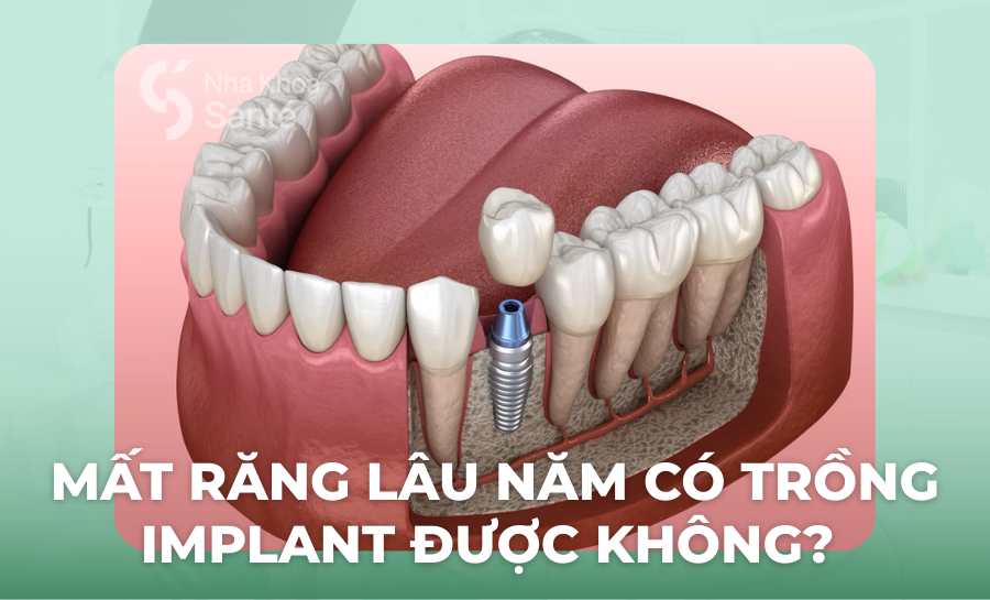 Mất Răng Lâu Năm Có Trồng Implant Được Không?