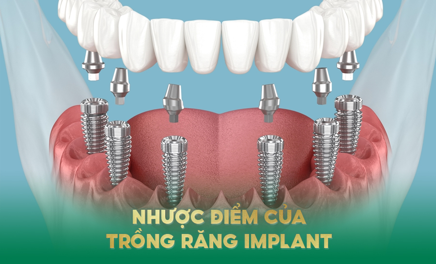 Nhược Điểm Của Trồng Răng Implant: Hiểu Đúng Để Chọn Đúng