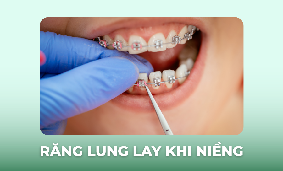 Răng Lung Lay Khi Niềng: Nguyên Nhân Và Cách Xử Lý An Toàn Hiệu Quả
