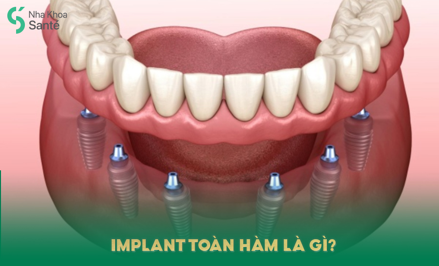 Implant Toàn Hàm Tại Nha Khoa Santé Nha Trang