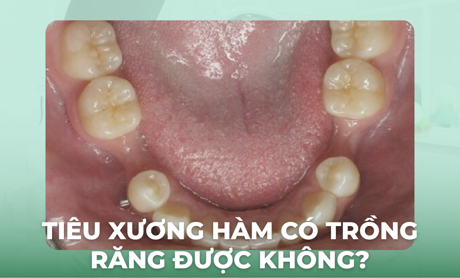 Tiêu Xương Hàm Có Trồng Răng Được Không?