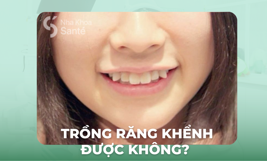 Trồng Răng Khểnh Được Không? Phương Pháp, Chi Phí Và Cách Chăm Sóc Hiệu Quả