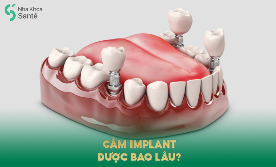 Cắm Implant Được Bao Lâu? Tất Cả Những Điều Bạn Cần Biết Trước Khi Thực Hiện