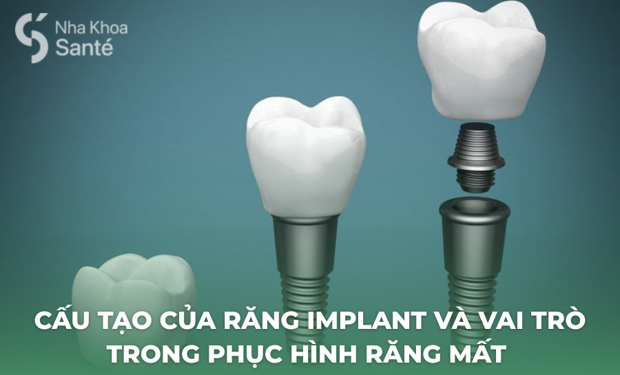 Cấu Tạo Của Răng Implant Và Vai Trò Trong Phục Hình Răng Mất