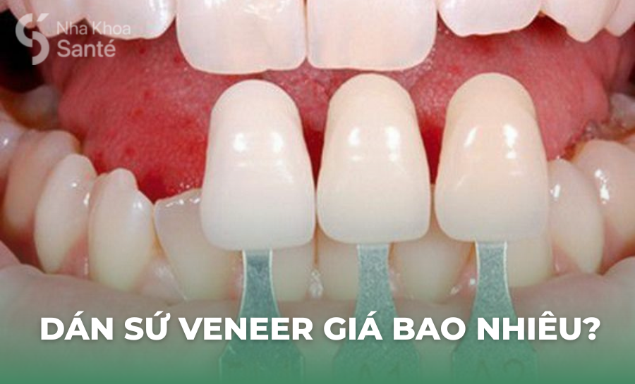 Dán Sứ Veneer Giá Bao Nhiêu? Bảng Giá Chi Tiết Và Bí Quyết Chăm Sóc Đạt Hiệu Quả