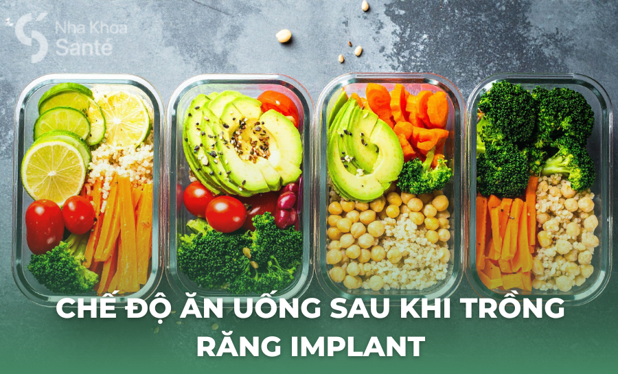 Chế Độ Ăn Uống Sau Khi Trồng Răng Implant: Thực Phẩm Nên Ưu Tiên Và Cần Tránh