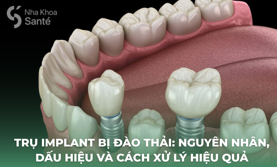 Trụ Implant Bị Đào Thải: Nguyên Nhân, Dấu Hiệu Và Cách Xử Lý Hiệu Quả