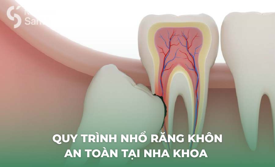 Quy Trình Nhổ Răng Khôn: Từ Thăm Khám Đến Hồi Phục