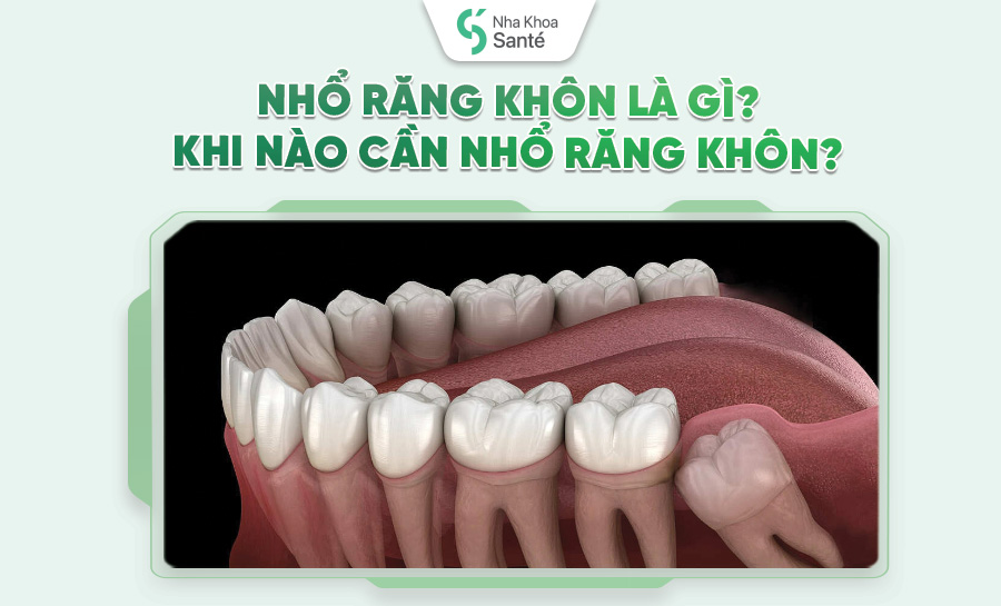Nhổ Răng Khôn: Quy Trình An Toàn Và Những Lưu Ý Quan Trọng Trước – Sau Khi Nhổ